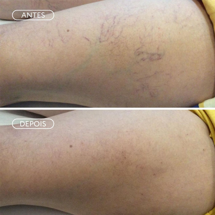 Skinbooster - Amo Estética Natal/RN