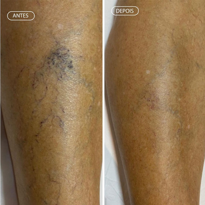 Resultado Skinbooster - Textura renovada