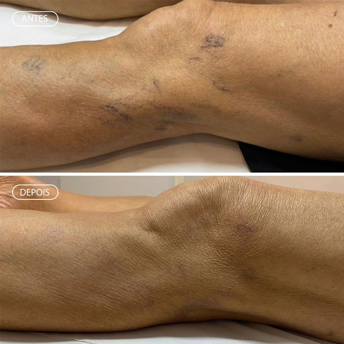 Resultado Skinbooster - Viço natural