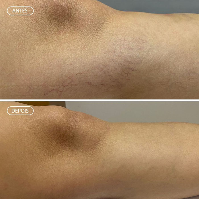 Resultado Skinbooster - Pele aveludada