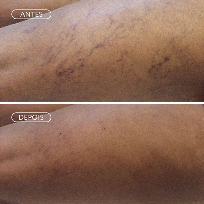 Resultado Skinbooster - Brilho saudável
