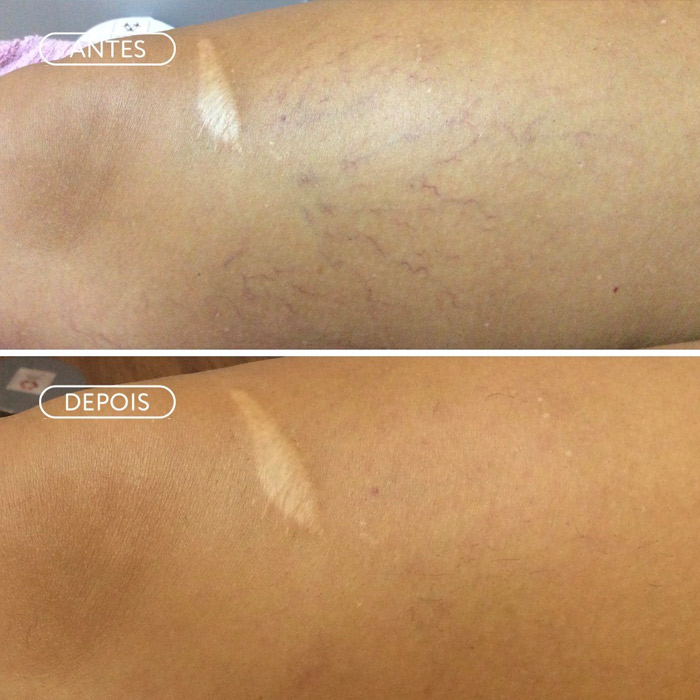 Resultado Skinbooster - Elasticidade