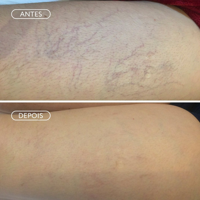 Resultado Skinbooster - Pele radiante